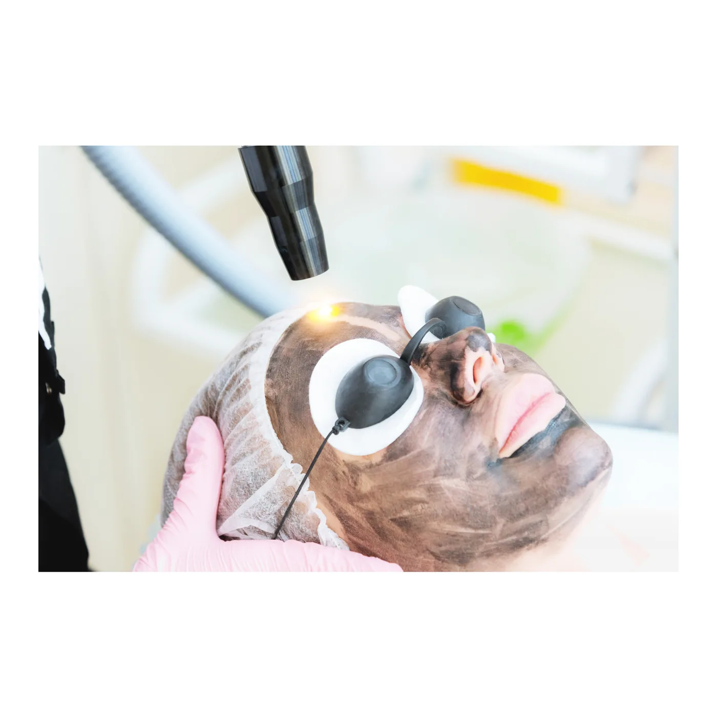 Hollywood Carbon Laser Treatment